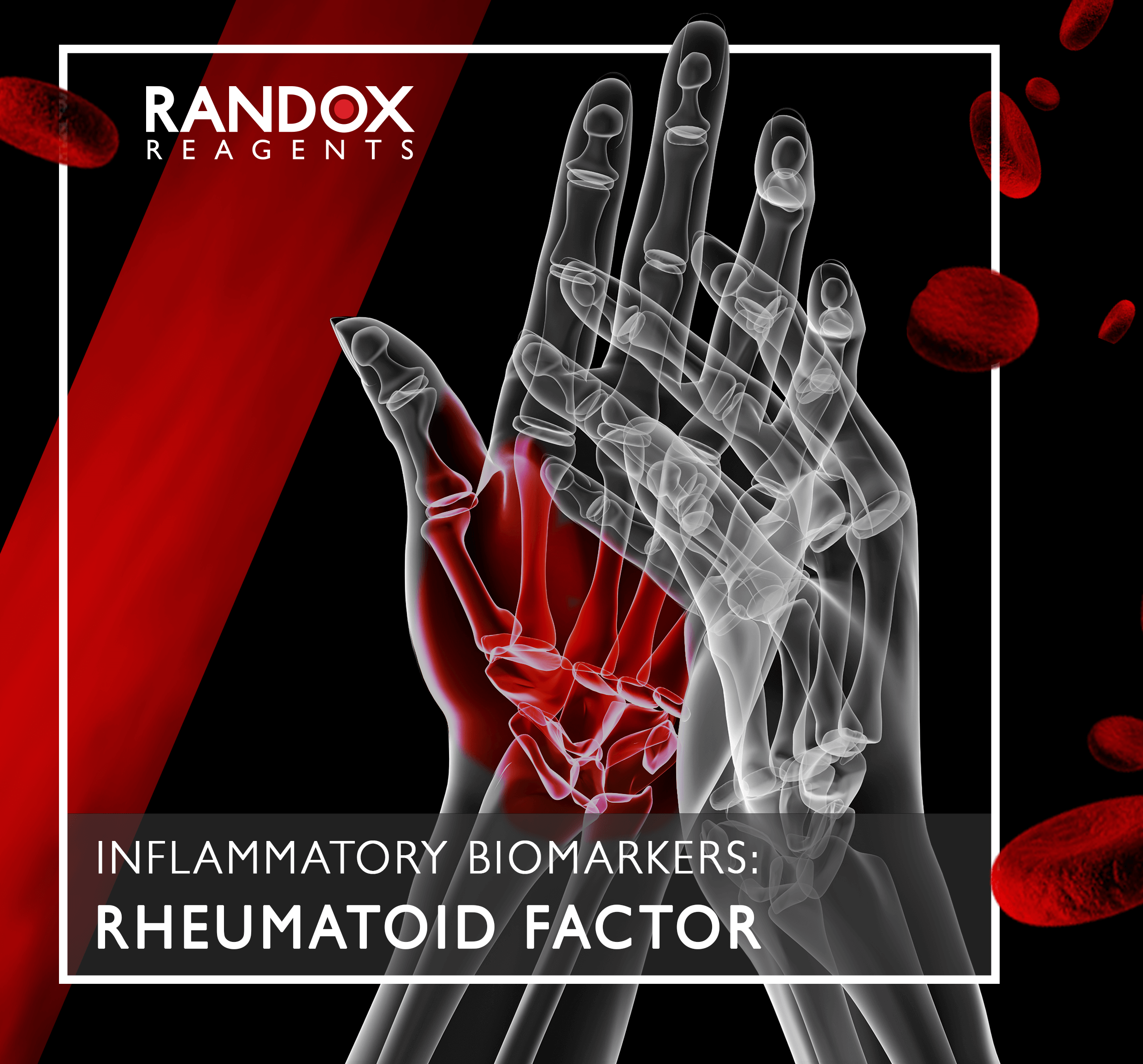 Inflammatory Biomarker: Rheumatoid Factor