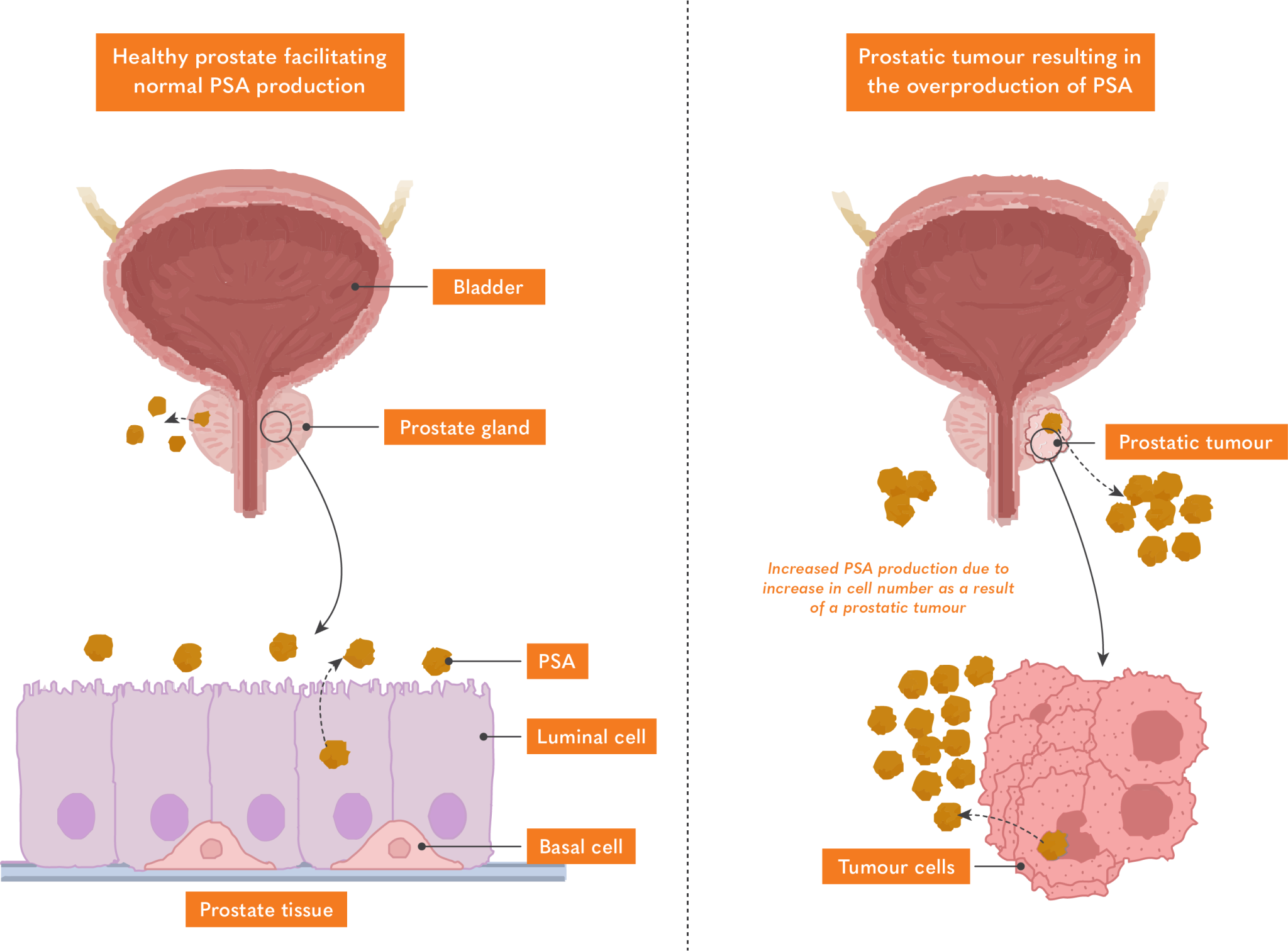 Prostate Specific Antigen Prostate Cancer Educational Guide   PSA Production In Tumours 2048x1512 